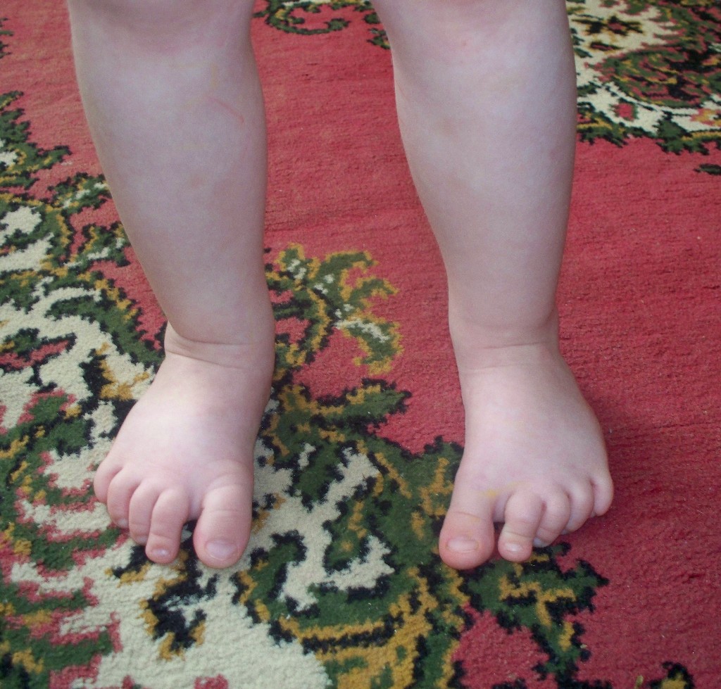 Почему дети поджимают ноги. Вальгусная косолапость. Приведение переднего отдела стопы у детей.