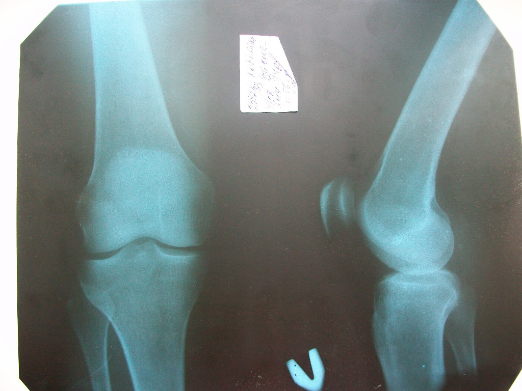 Трещина связке. Вывих надколенника рентген. Перелом надколенника рентген. Фиброма коленного сустава рентген. Ушиб коленного сустава рентген.