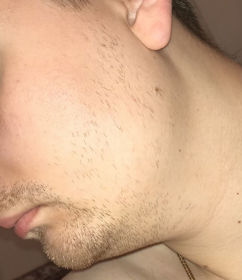 Не растет борода на щеках что делать в 30 лет