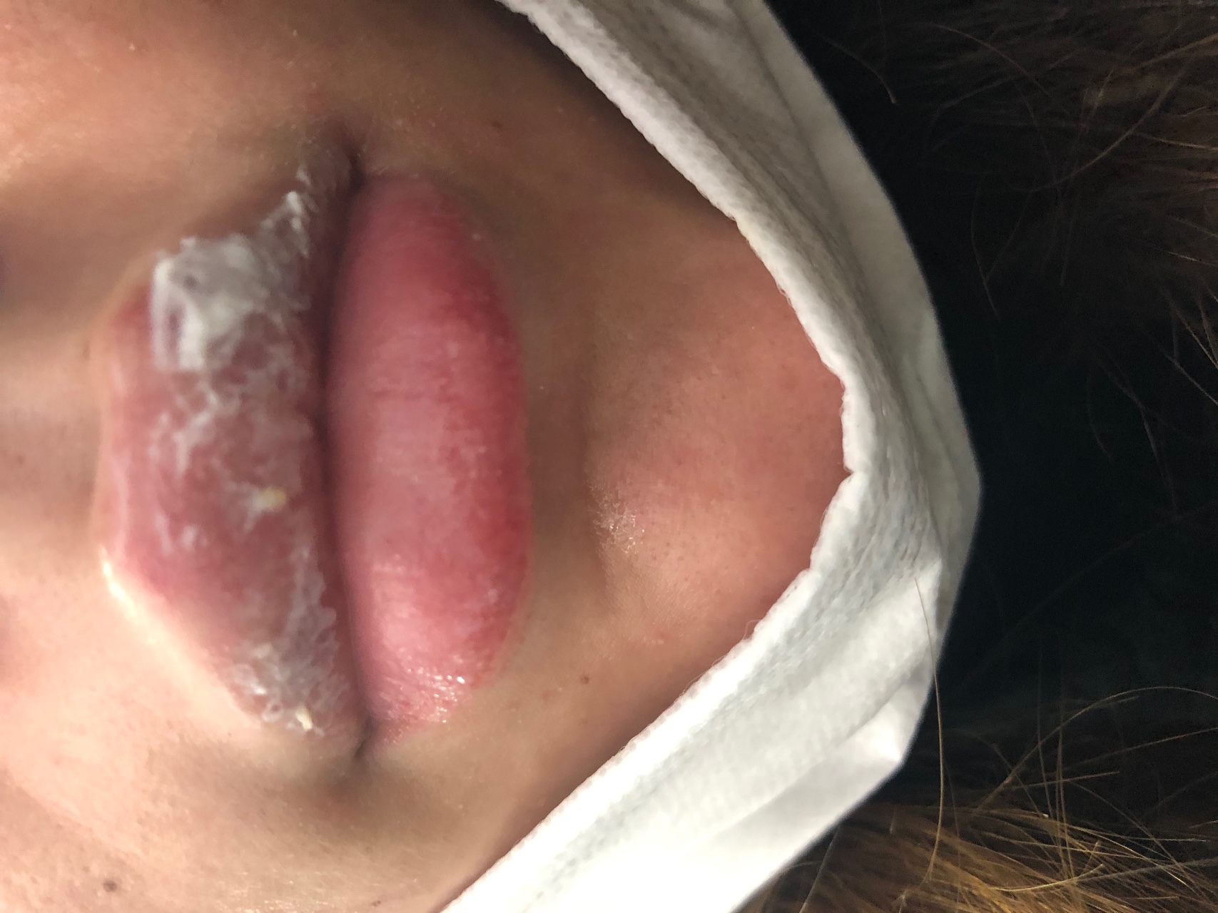 Аллергия на малых половых губах фото