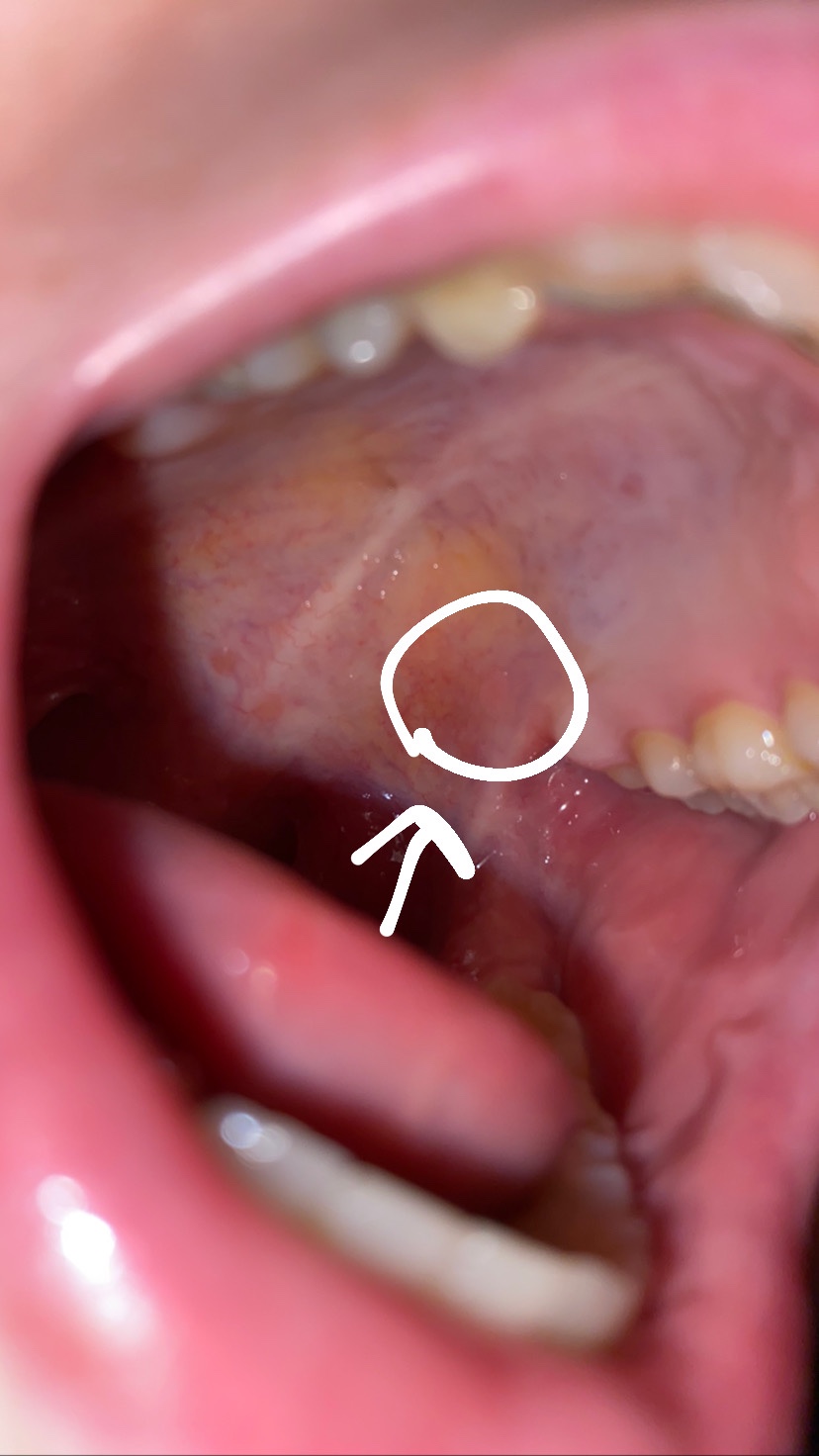 Опухоль на языке сбоку фото