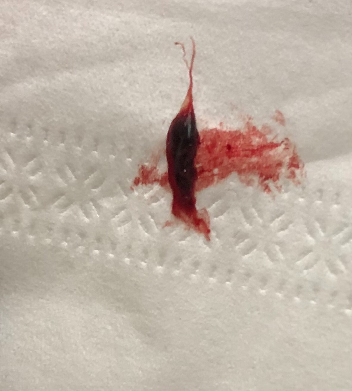 сгустки крови в сперме мужчин фото 106