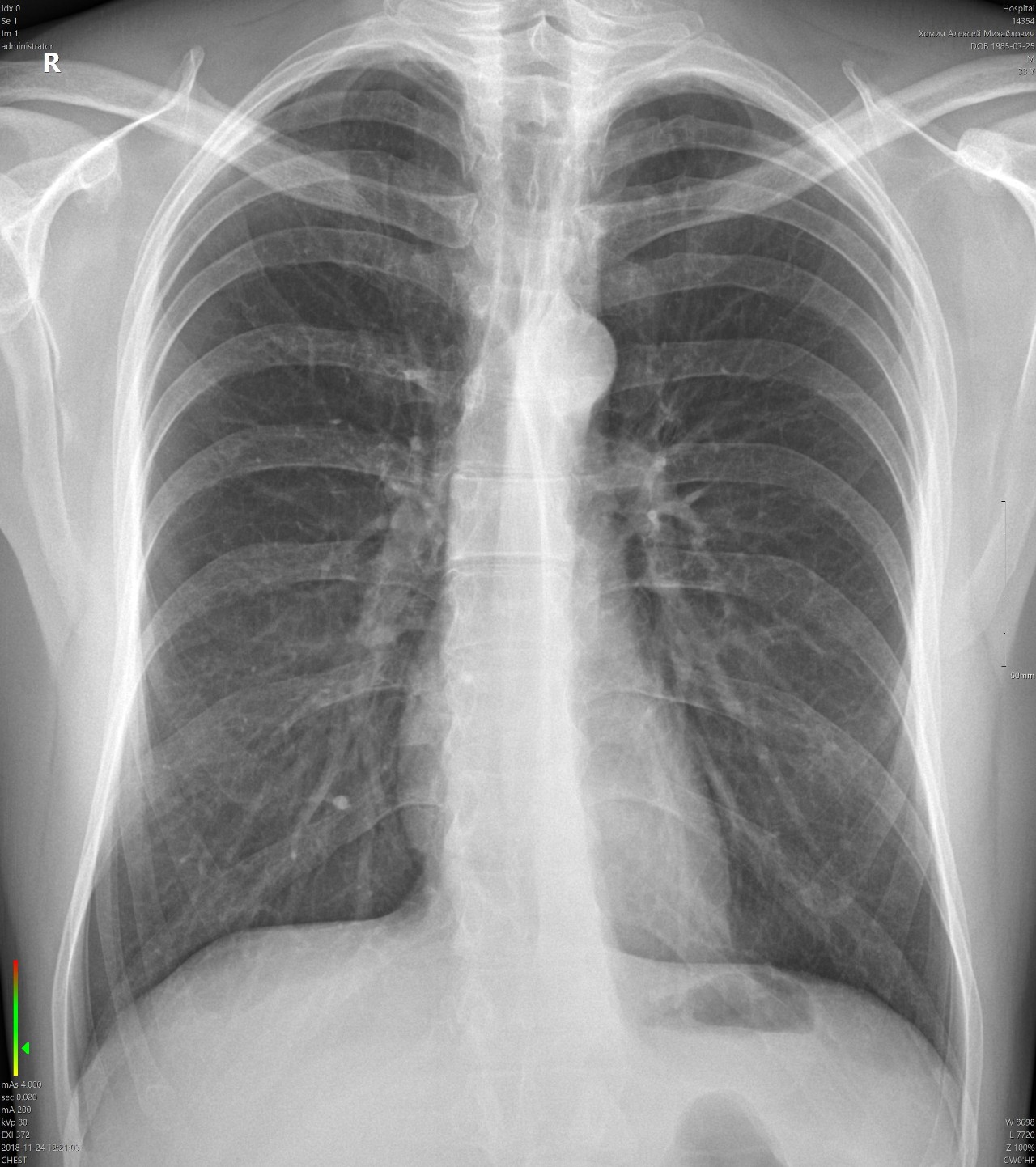 Расшифровка рентгеновских снимков легких