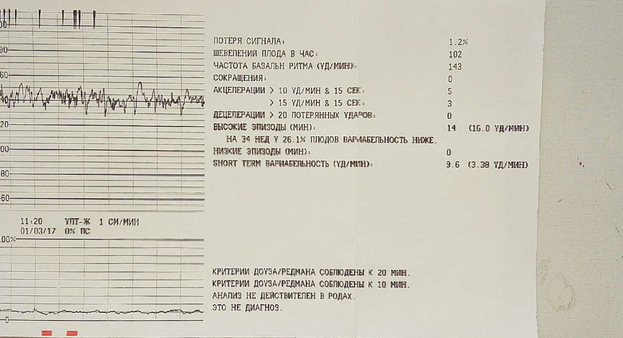 Почему не чувствую шевелений ребенка