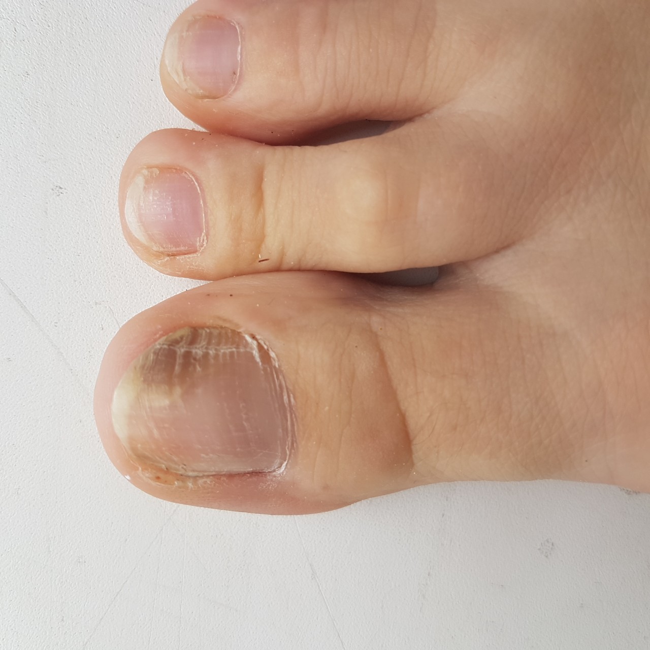 Меланома под ногтем на ноге