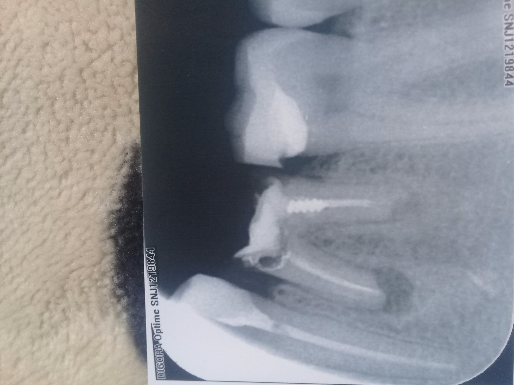 Затемнения на рентгене зубов
