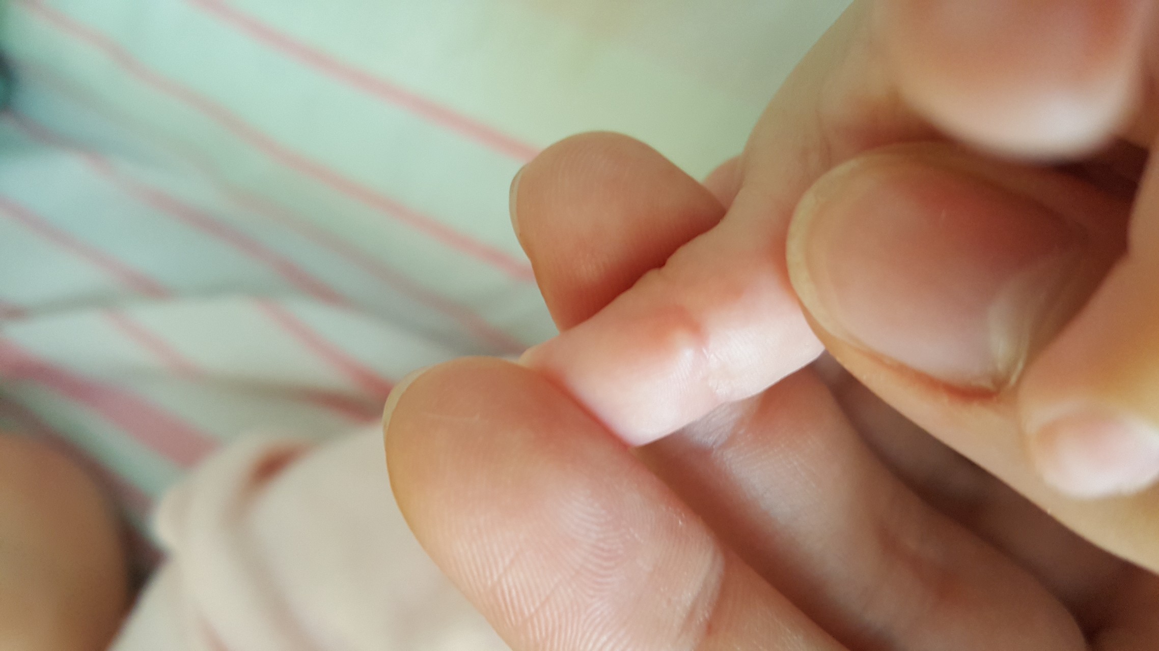 ребенок уронил на палец табуретку