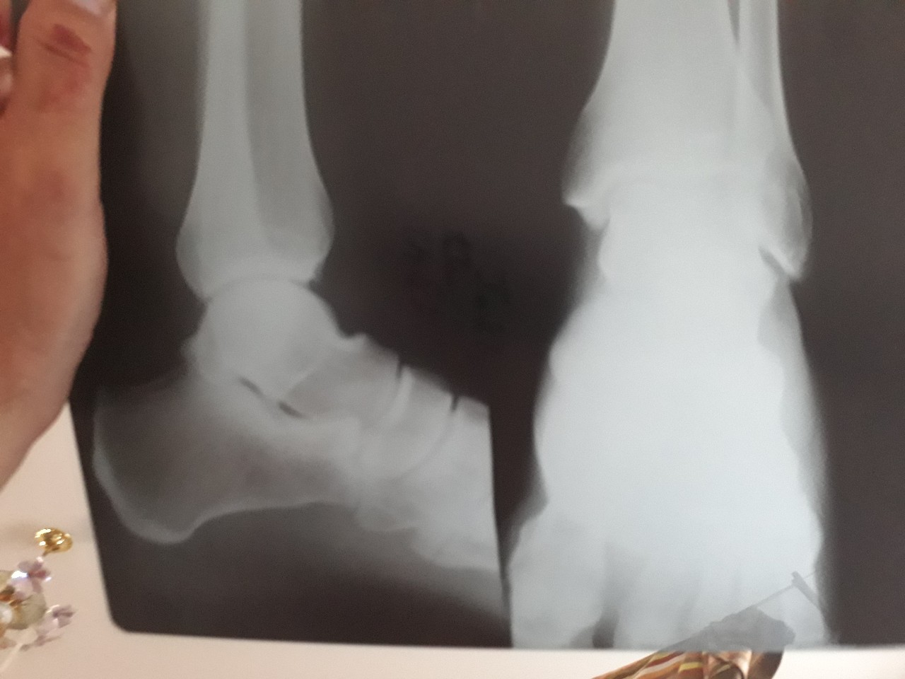 Перелом ноги на снимке рентген