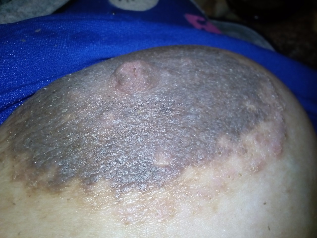 шелушится кожа на груди во время беременности фото 13