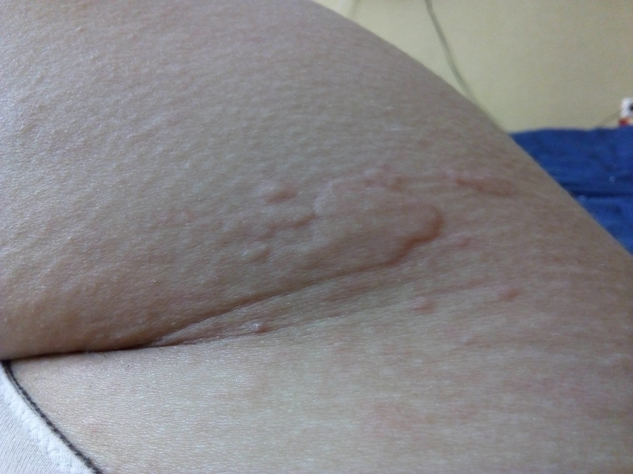 аллергия по телу по сперму фото 92