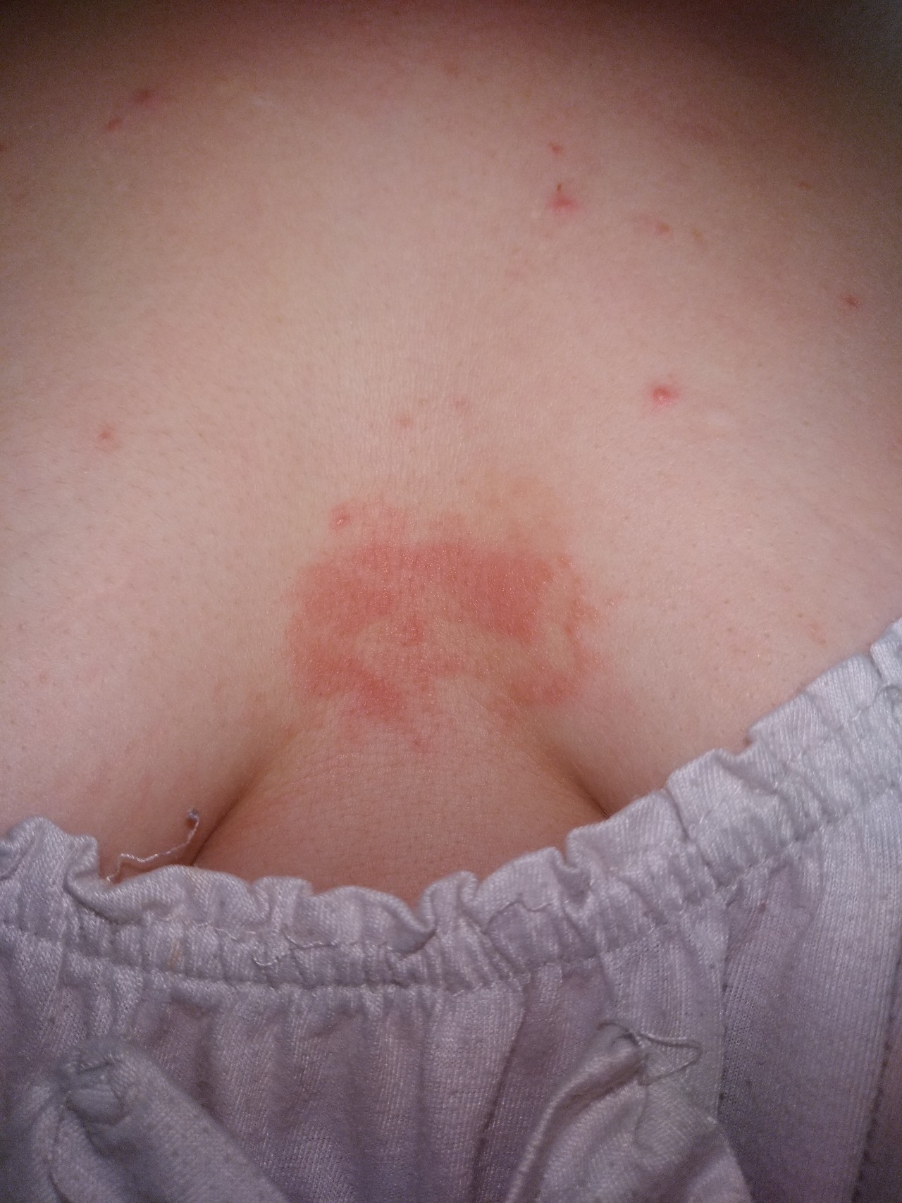 красные высыпания на груди у женщин фото 47