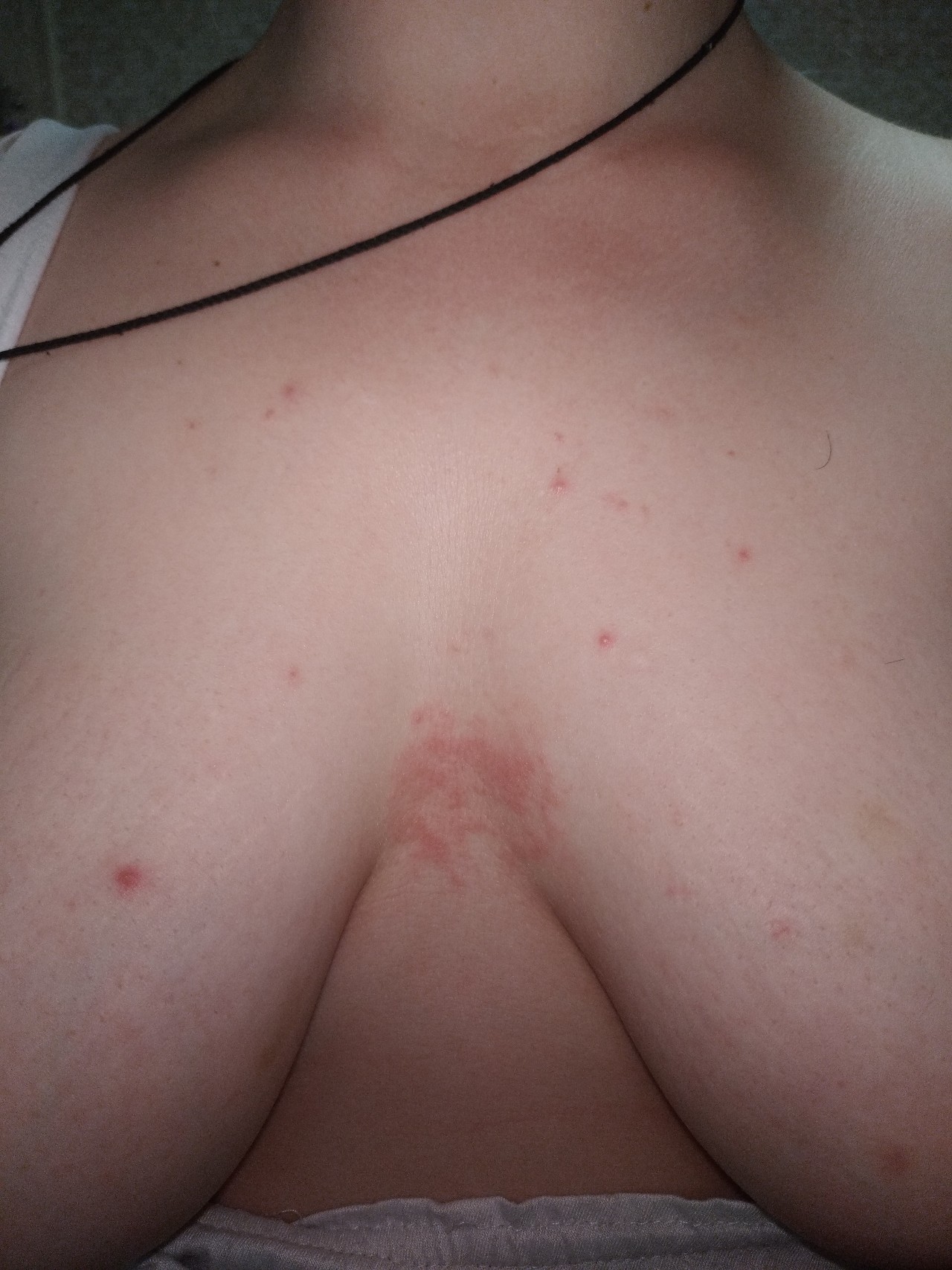 красная сыпь на груди у женщин что это фото 66