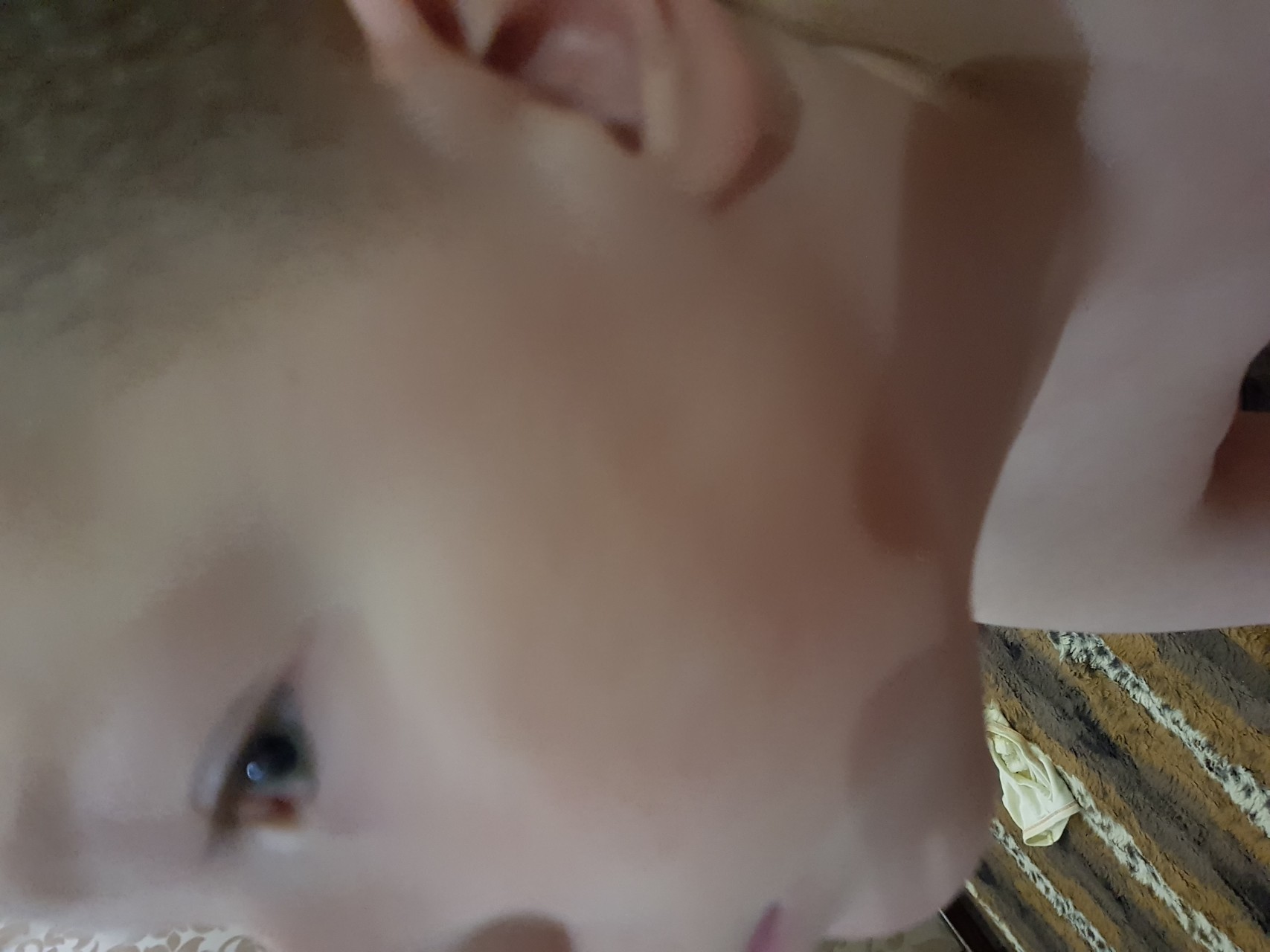 Белое пятно на щеке у ребенка