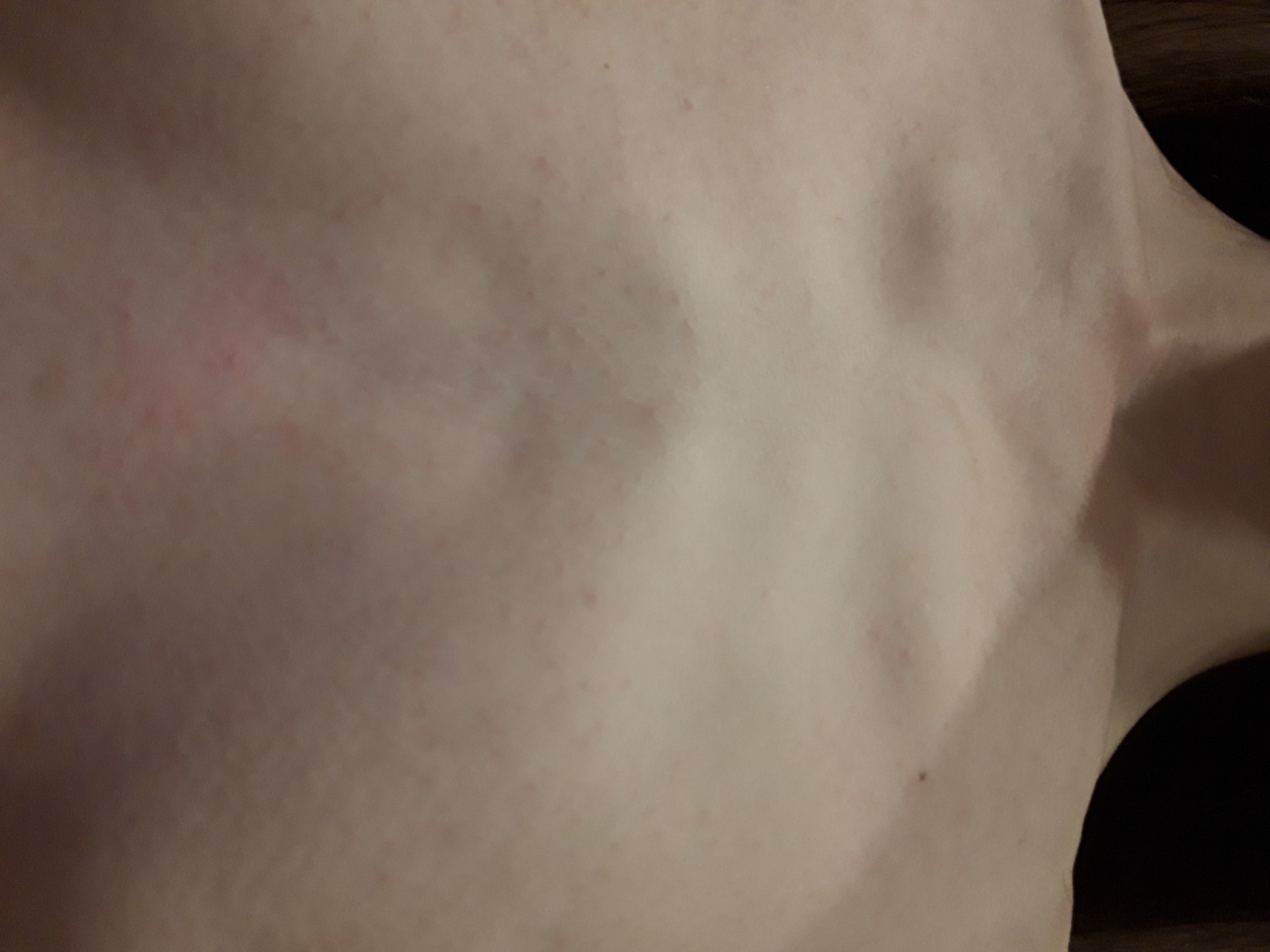 красные высыпания на груди у женщин фото 79