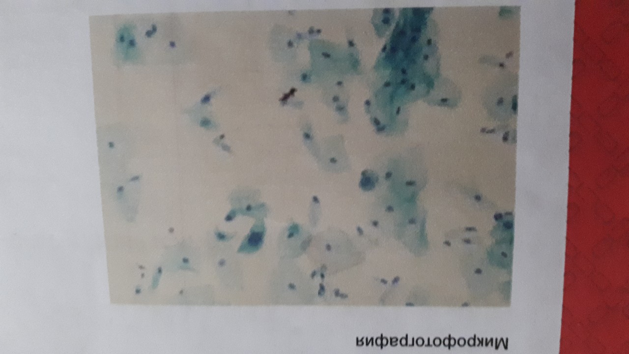 Метаплазированный эпителий в мокроте. Цитология микрофотографии Малом размере. Жидкостная цитология мелкодисперсная. Группы клеток метаплазированного