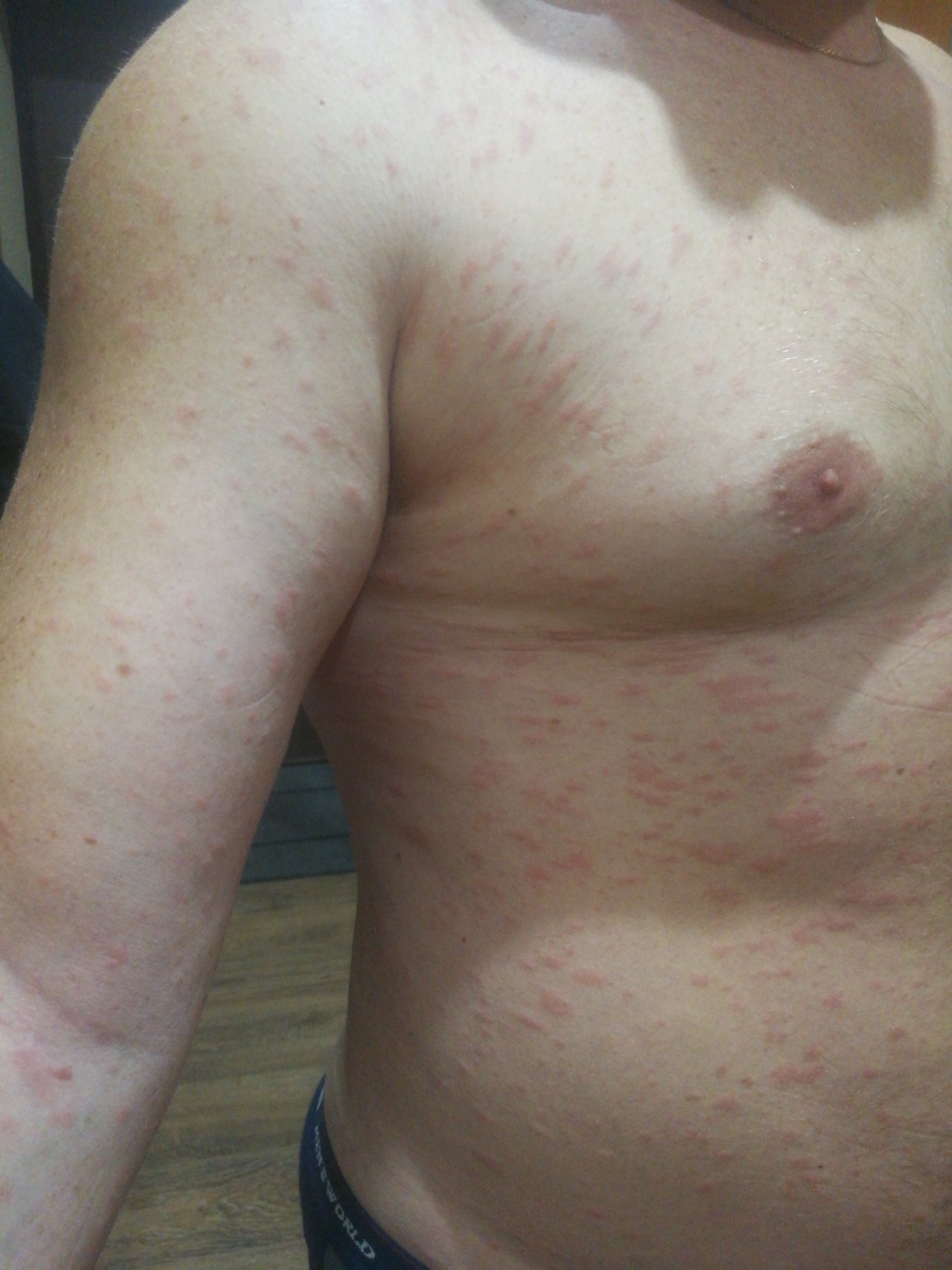 аллергия по телу по сперму фото 82