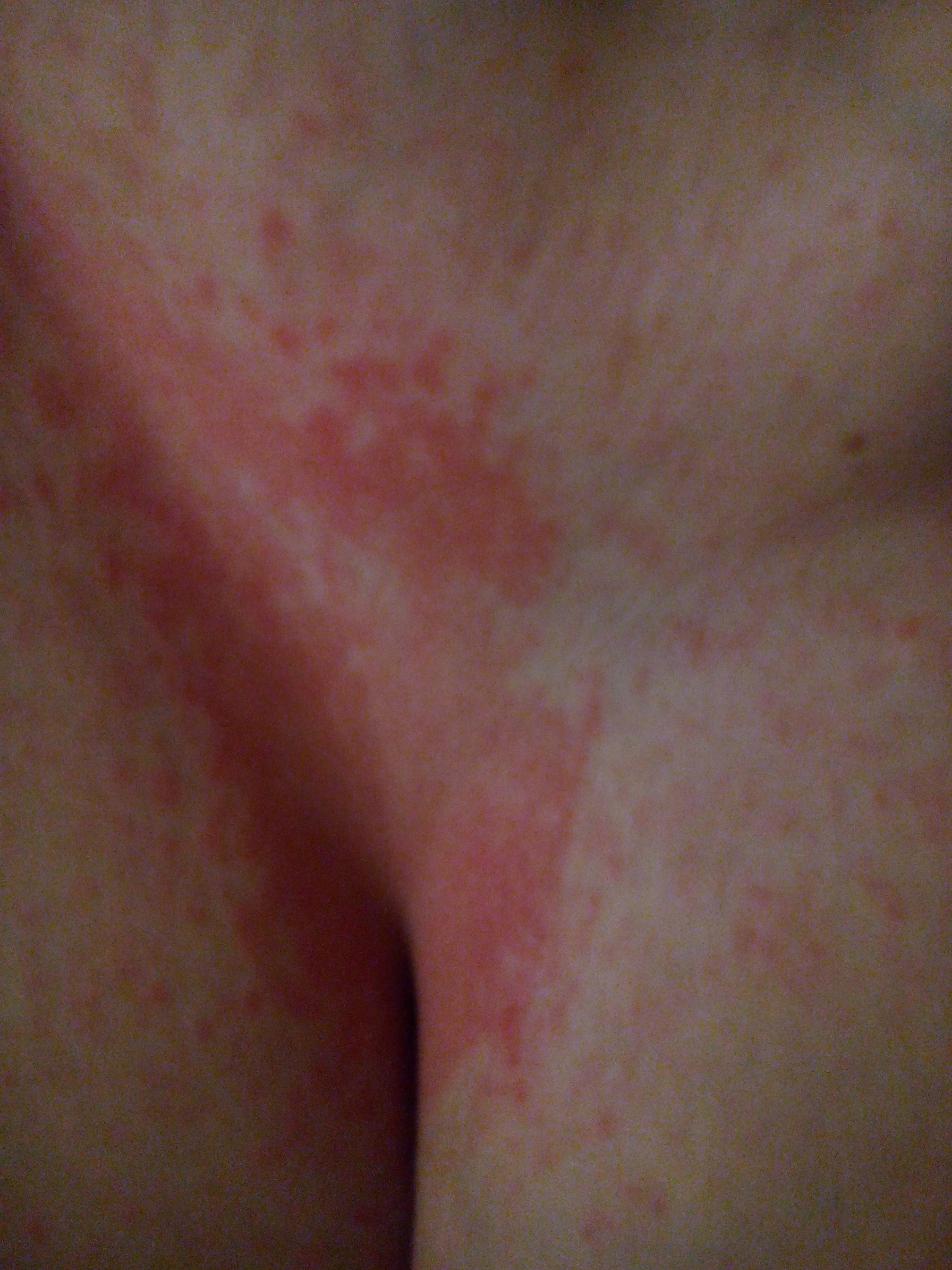 сыпь между грудей у женщин фото 28