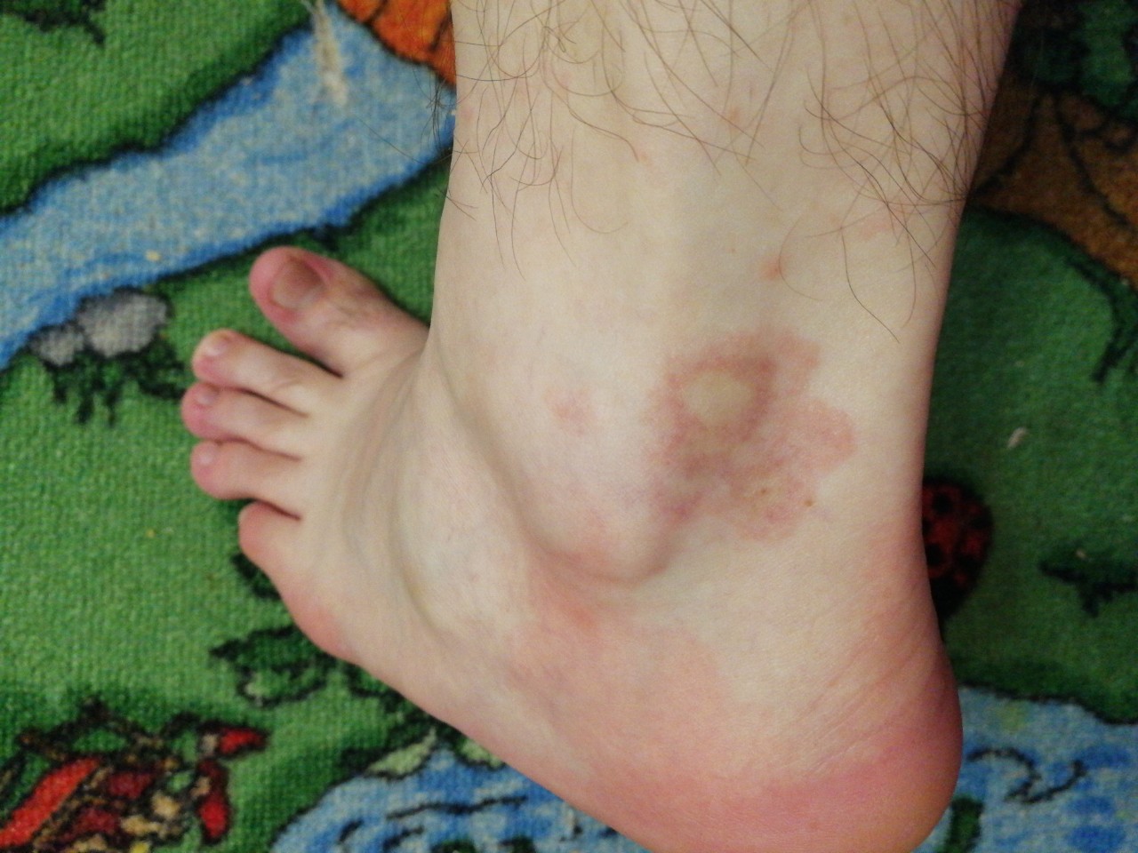 Красные пятна на ногах фото и диагноз