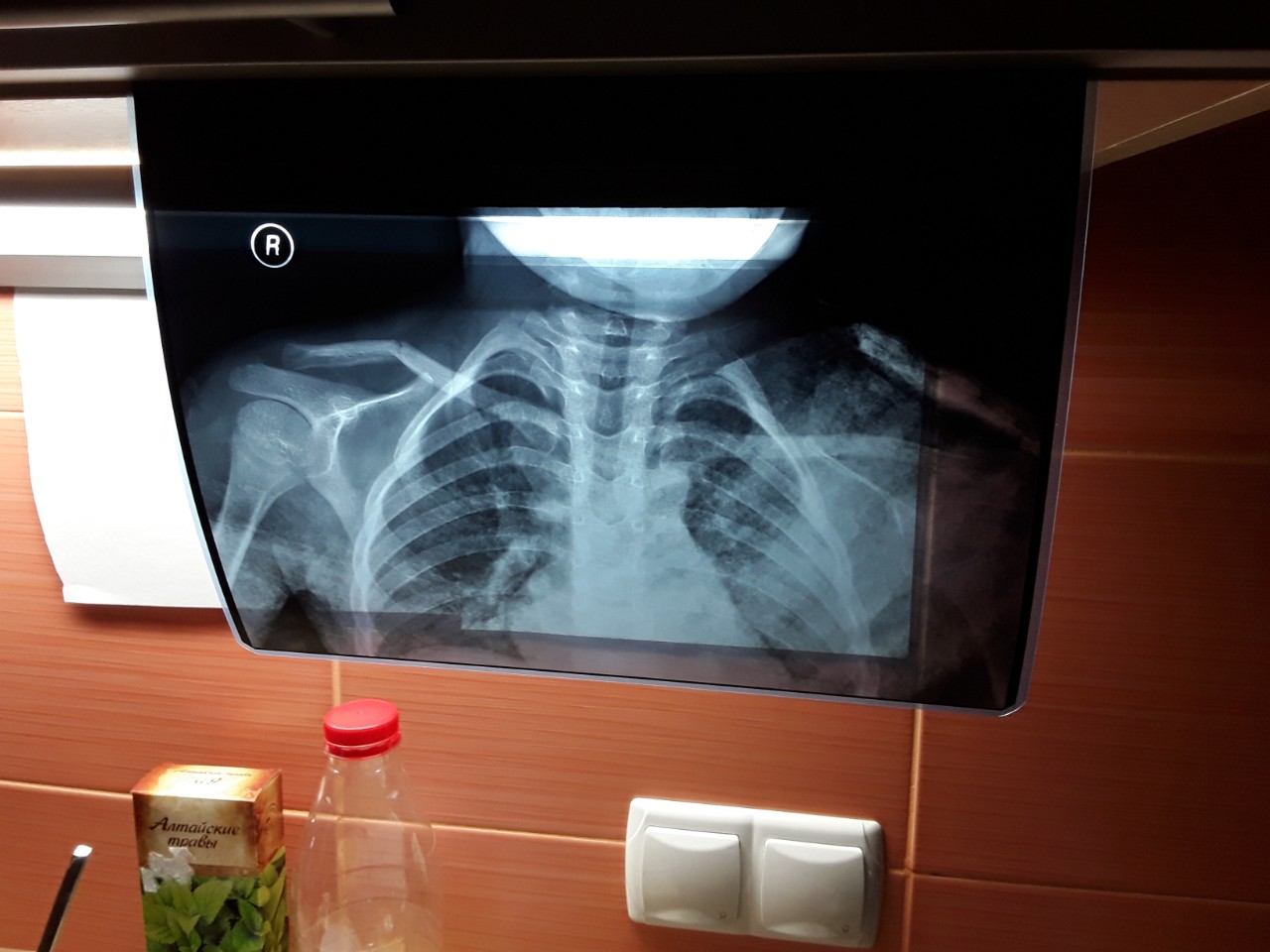 Ключица ребенок 5 лет рентген