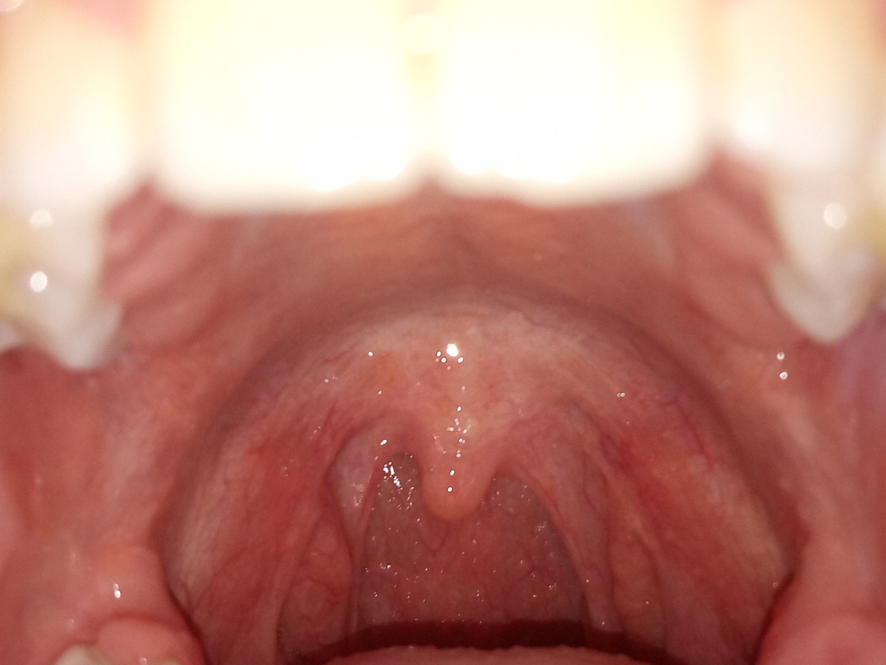 Лечение кисты в горле (на миндалине)