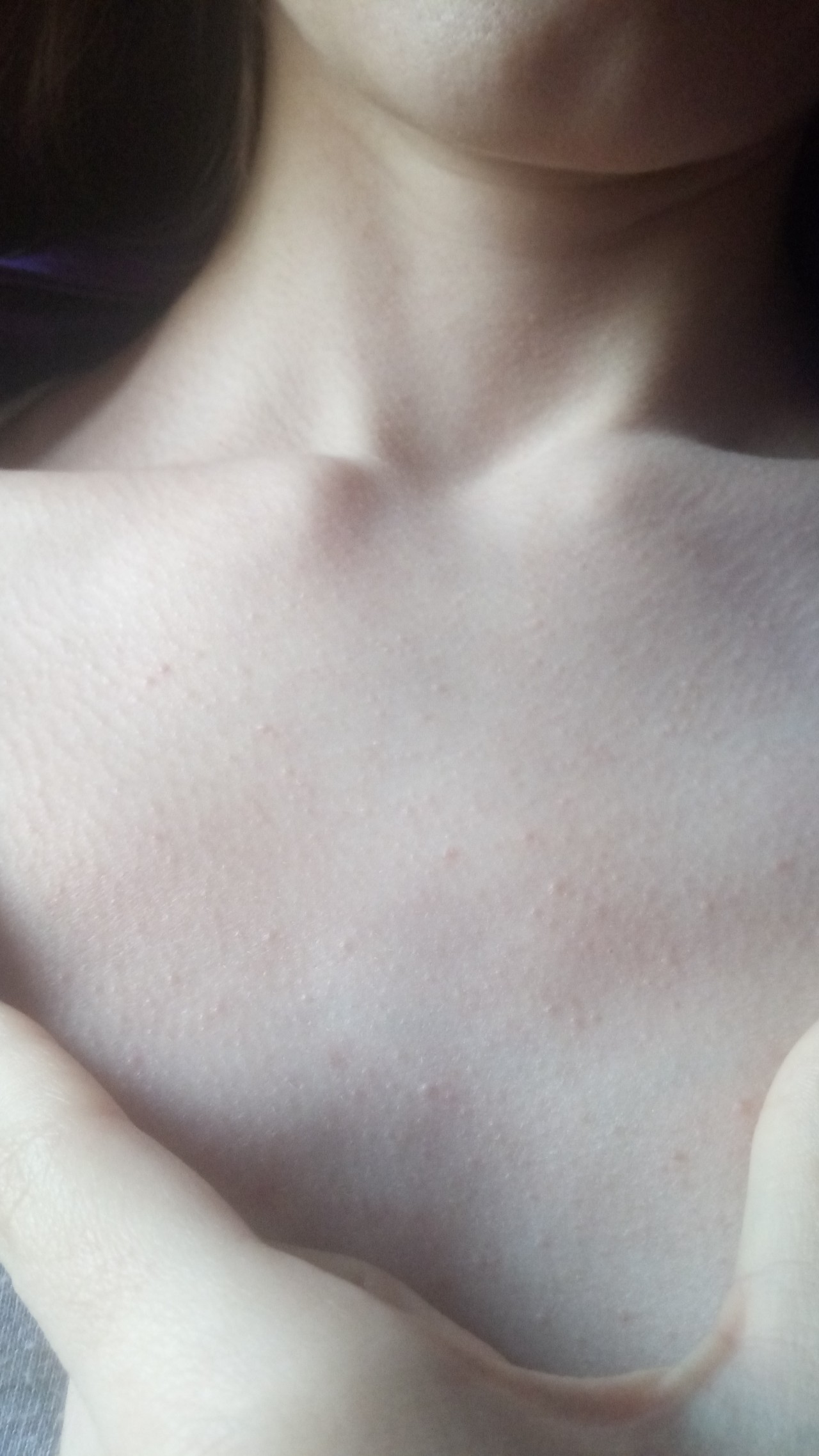 мелкая сыпь на груди у женщин фото 35