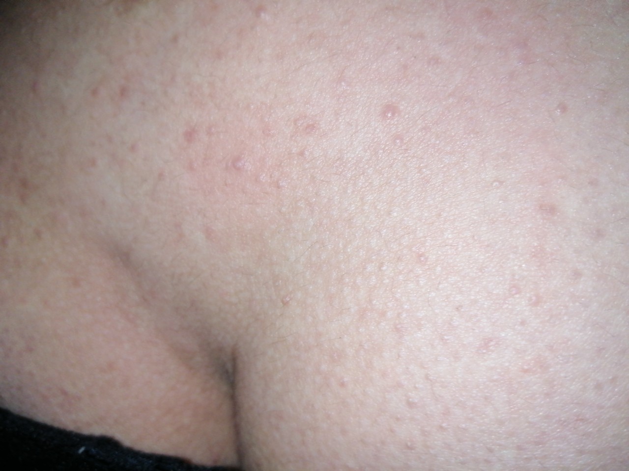 сыпь на груди у мужчин причины фото 71