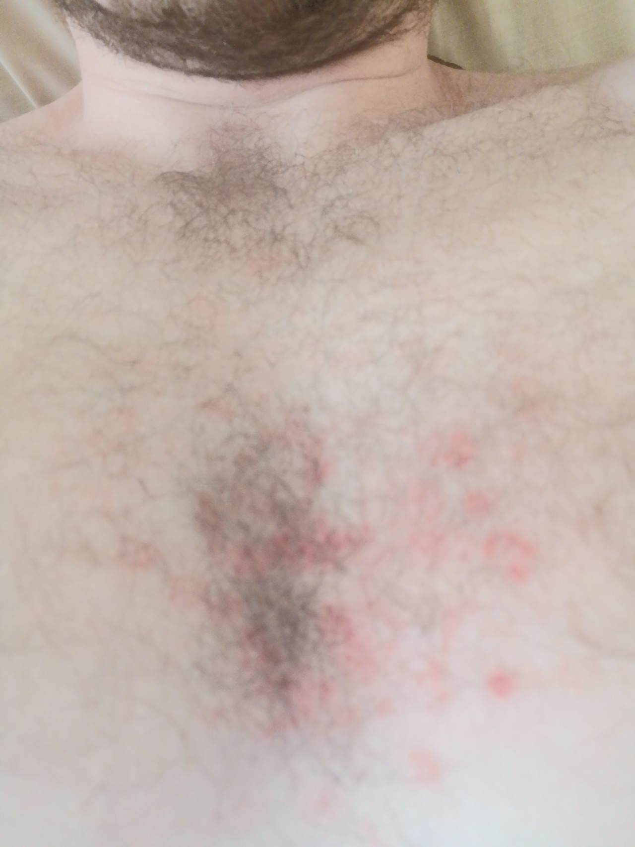 покраснение кожи на груди у мужчин причины фото 30