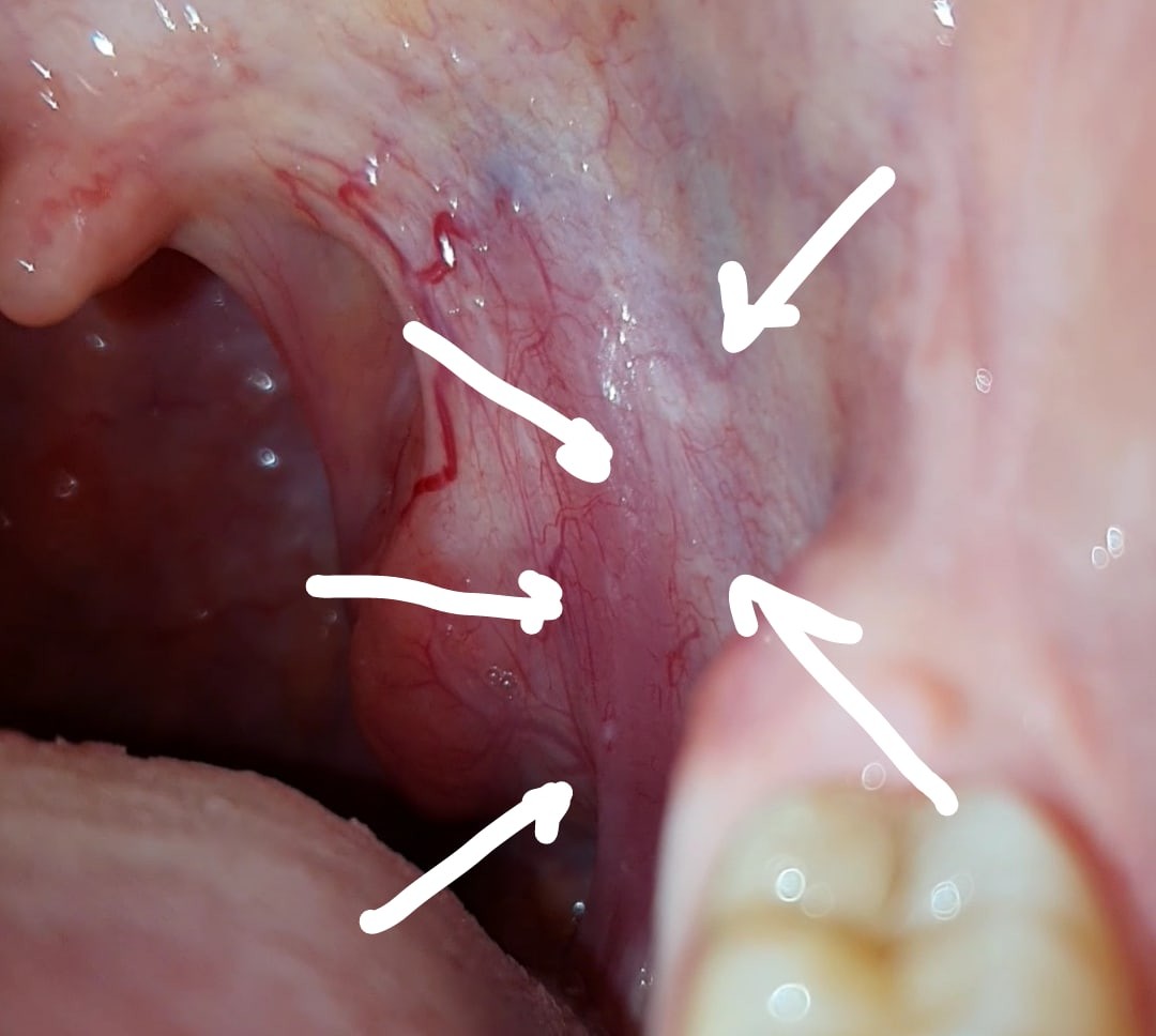Опухшие миндалины в горле фото
