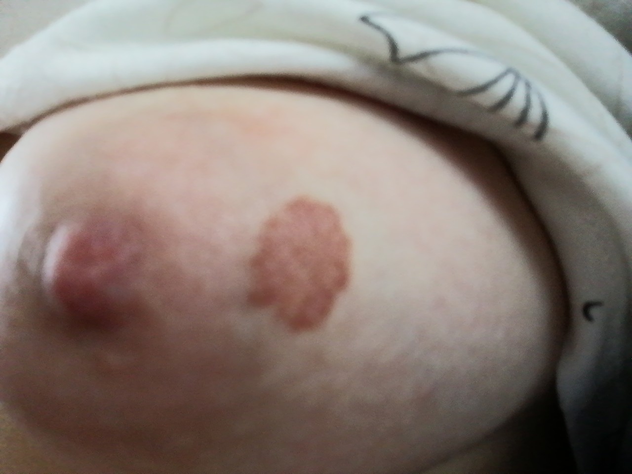 коричневые пятна на груди во время беременности фото 36