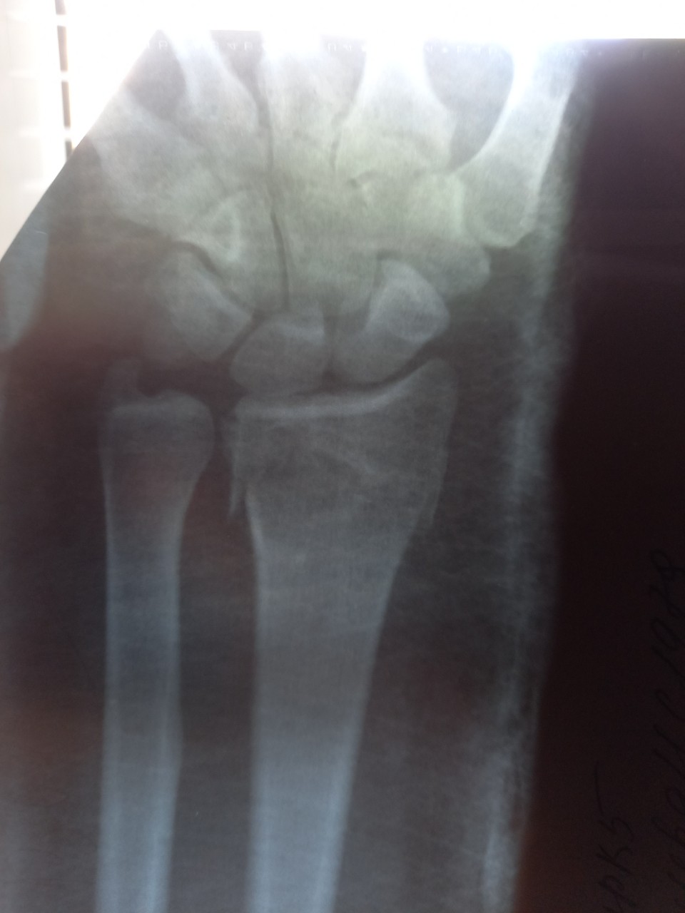 Шиловидный отросток лучевой кости перелом без смещения фото лечение