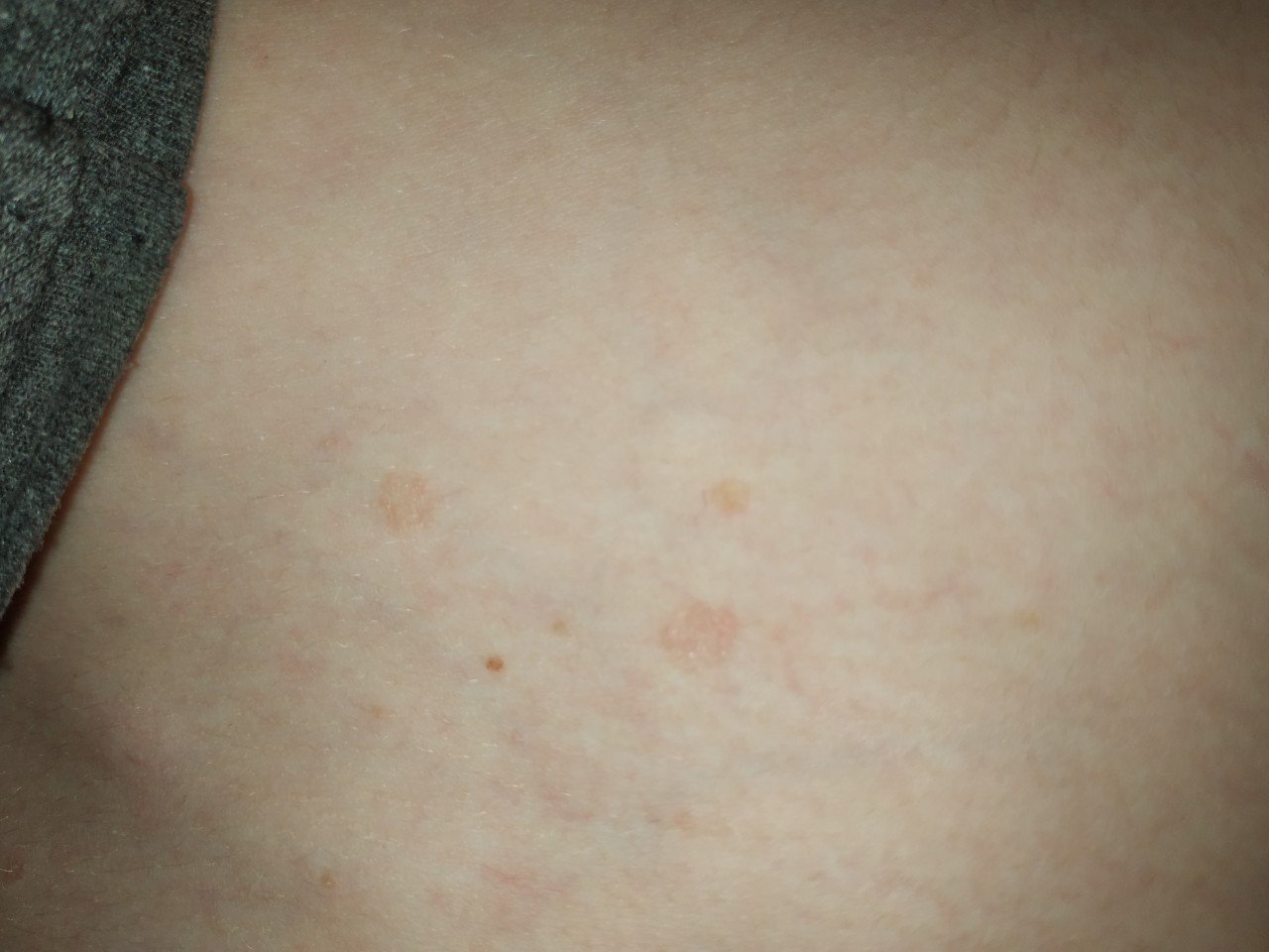 светло коричневые пятна на груди у женщин фото 114