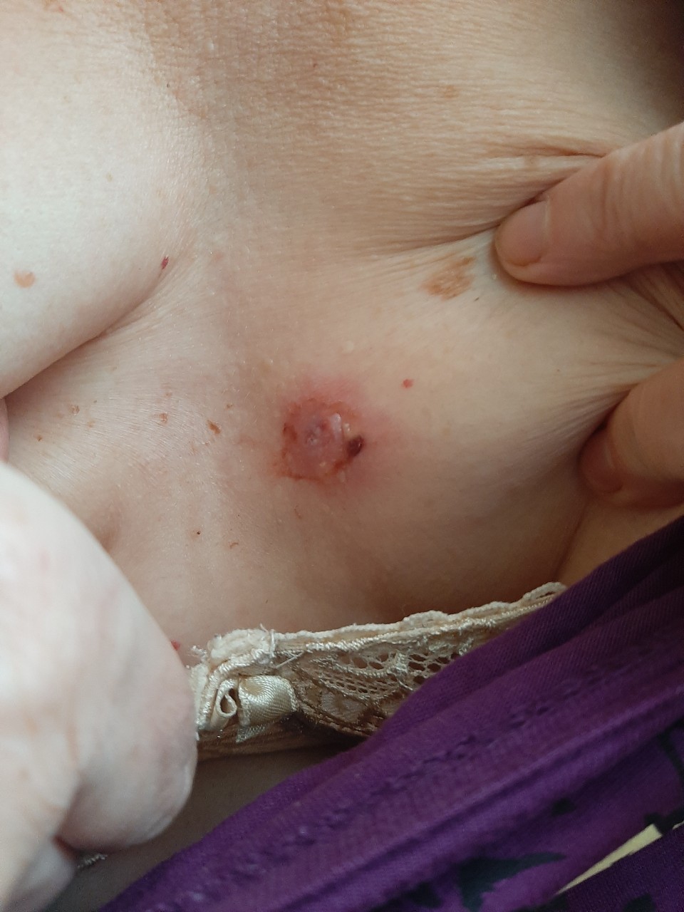 фурункул на груди у женщин фото 6