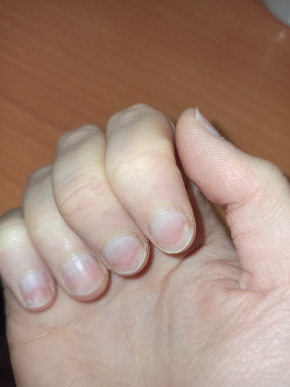 Онихолизис ногтей на руках после гель лака фото