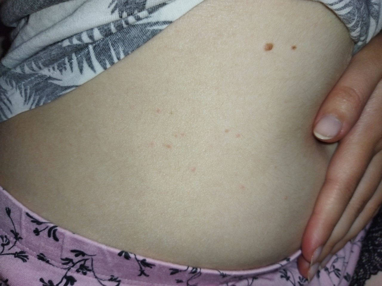 прыщи на спине и груди при беременности фото 20
