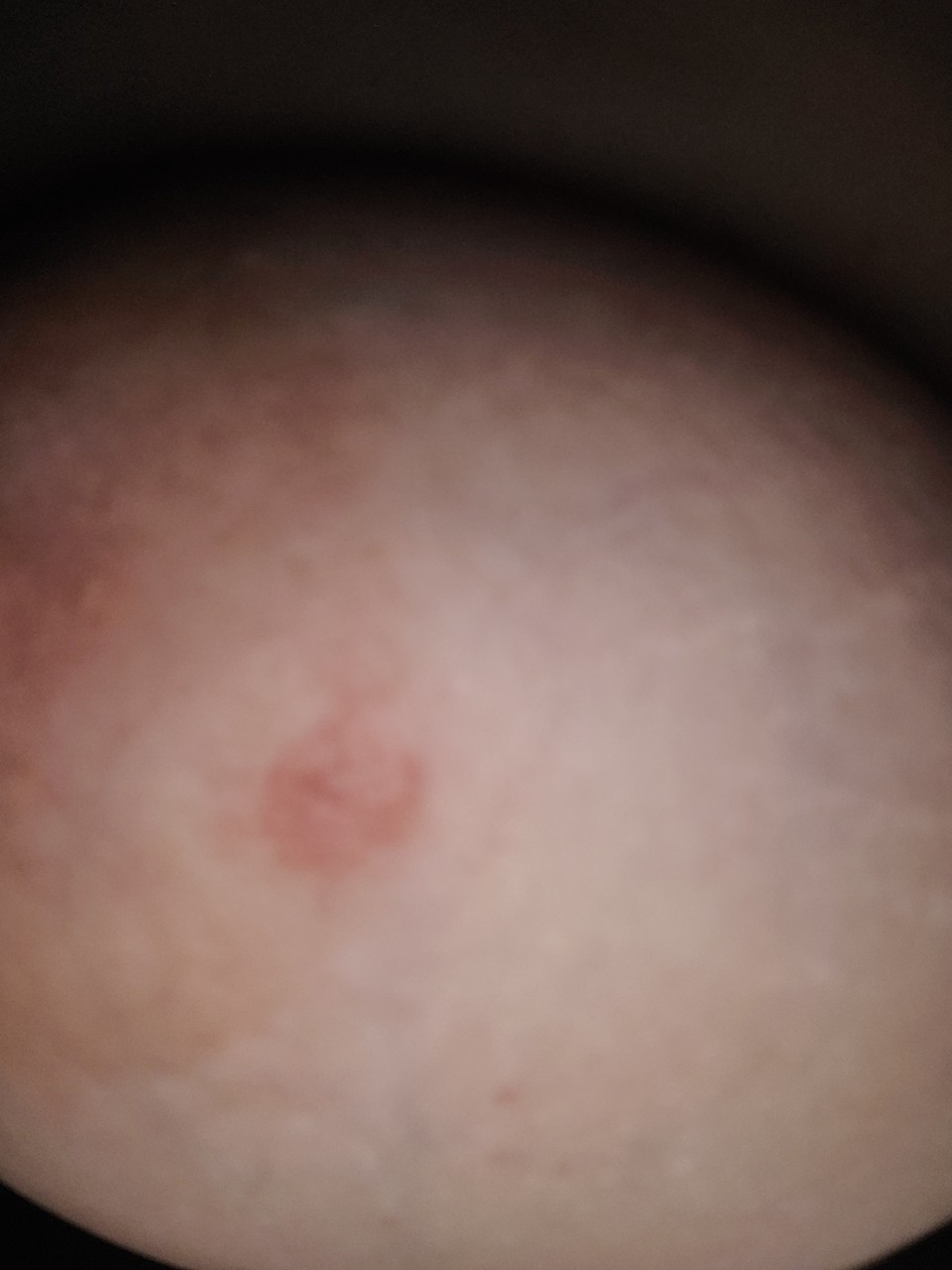 беременность красные пятна на груди фото 2