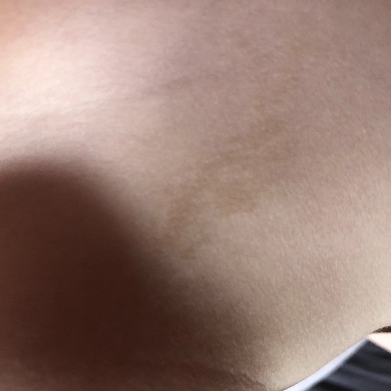 светлые пятна на груди женщин фото 112