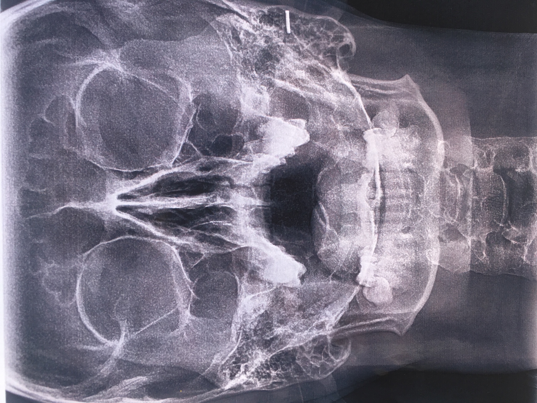 Рентген околоносовых пазух