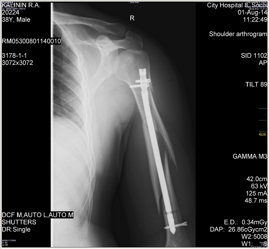 Перелом плеча оскольчатый