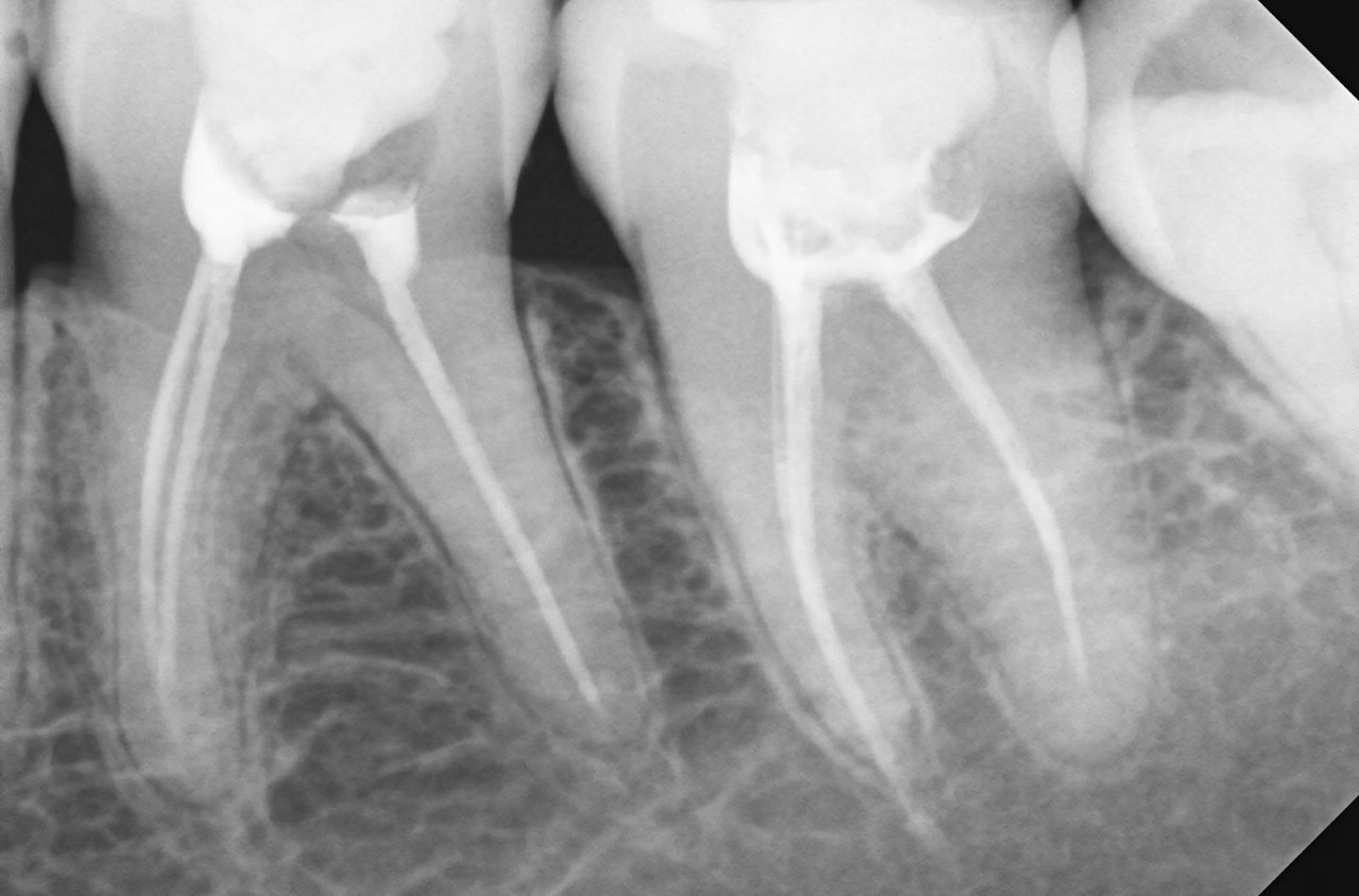 Запломбированные корневые каналы на рентгене