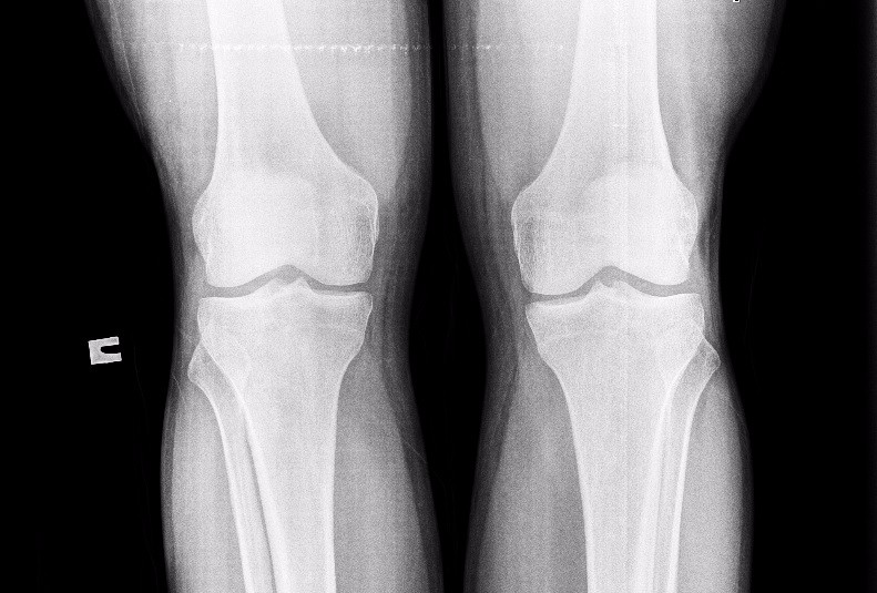 Трещина в коленной. Перелом коленного сустава рентген. Вывих надколенника рентген. Перелом надколенника рентген. Перелом коленного сустава мкб.