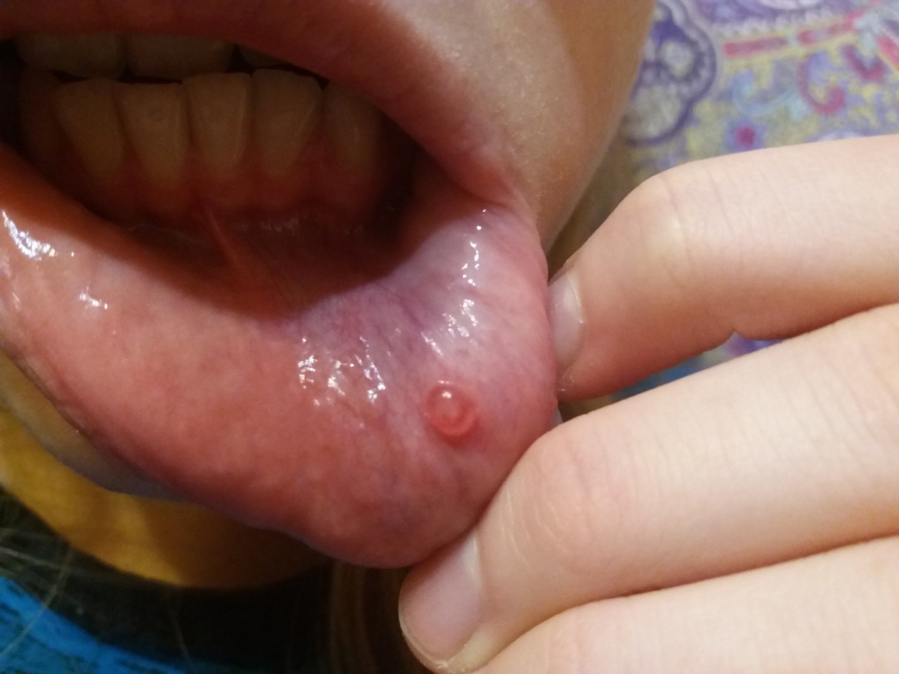 Пузырьки на губах: причины и лечение