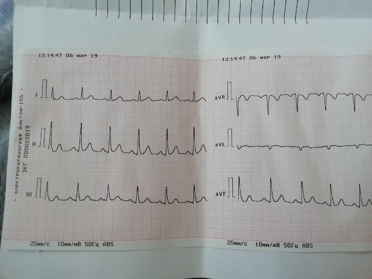 Результаты экг. Кардиограмма с болью в груди. ЭКГ боли 8 дней. ЭКГ боль. Фото кардиограммы с результатом тахикардия.