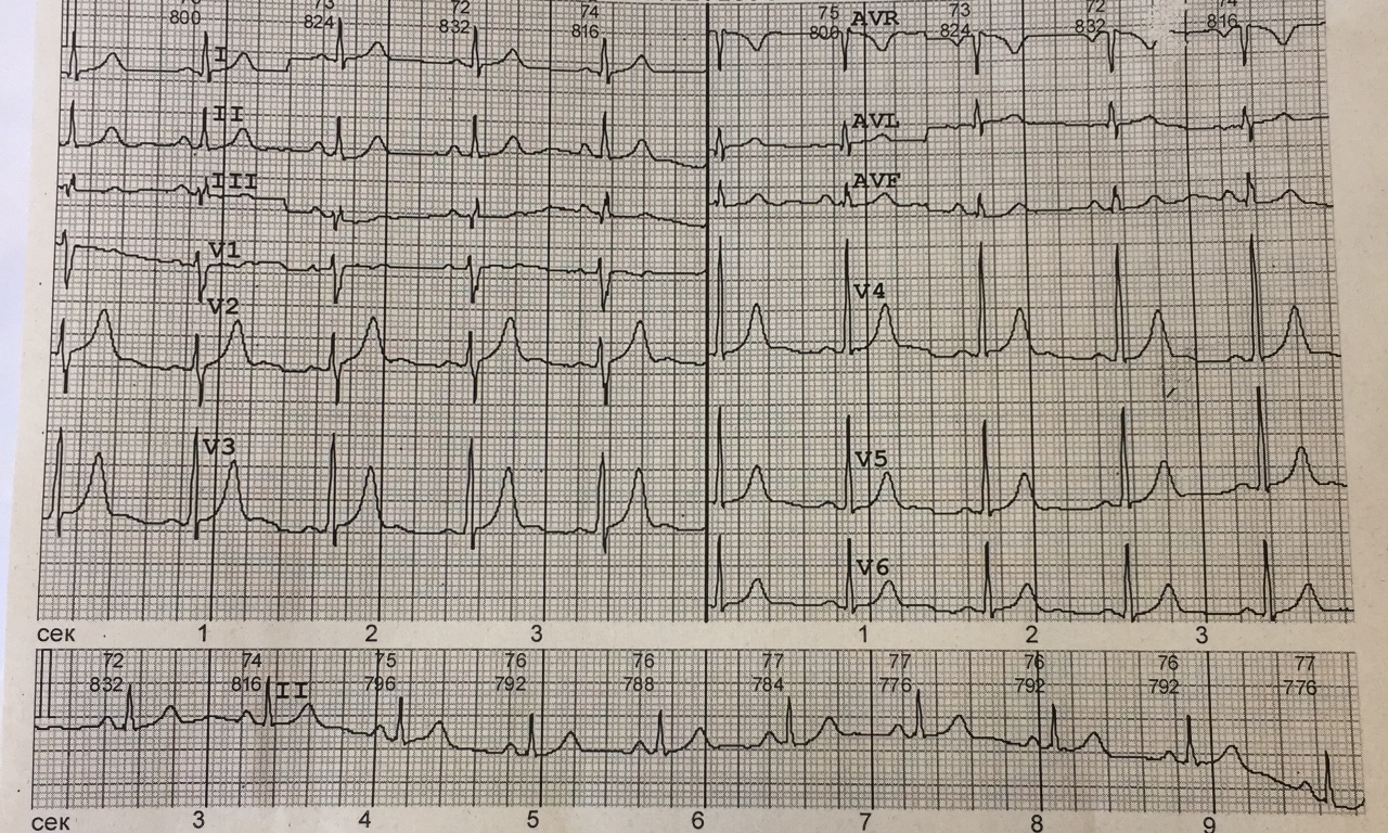 Расшифровка кардиограммы