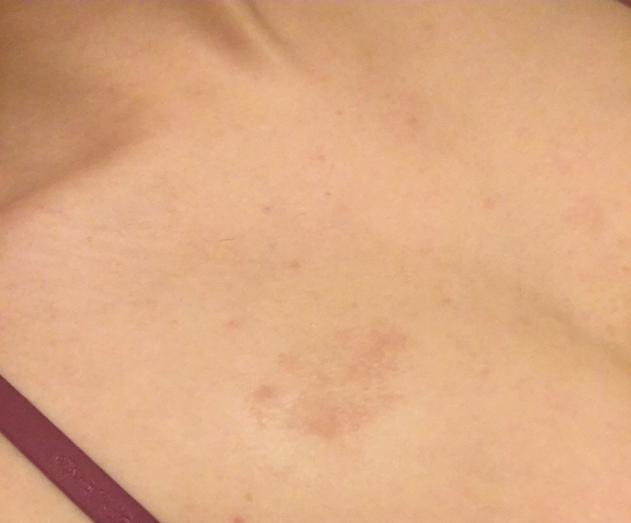 коричневые пятна на груди у женщин (120) фото