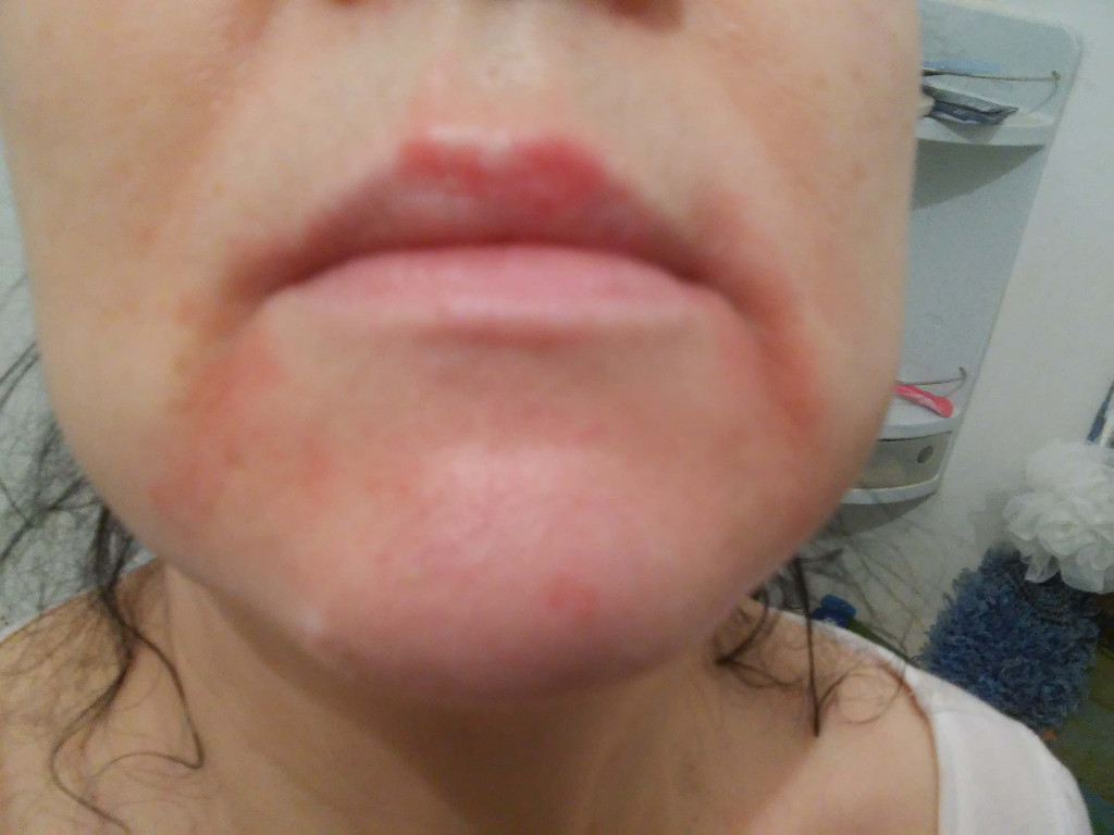 Розовые пятна на лице - Вопрос дерматологу - 03 Онлайн