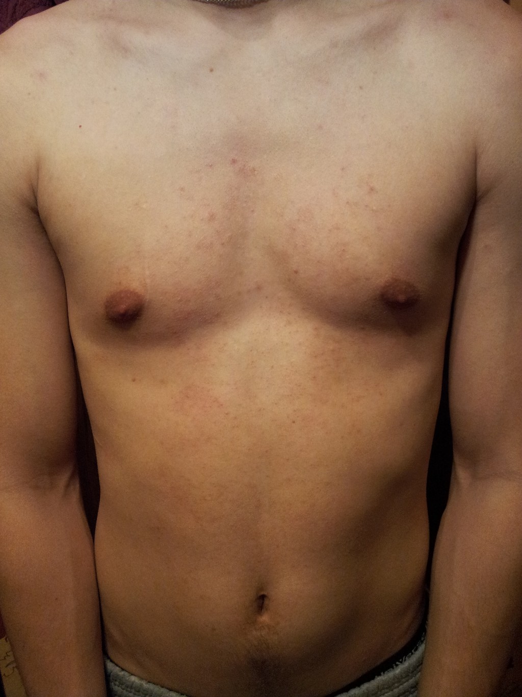 сыпь в области груди у мужчин фото 1
