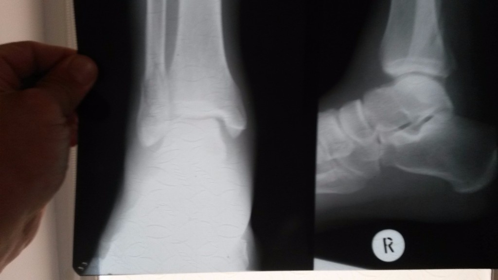 6 недель перелом. Перелом наружной лодыжки рентген. Апикальный перелом наружной лодыжки рентген. Подвывих стопы кнаружи рентген. Апикальный перелом лодыжки.