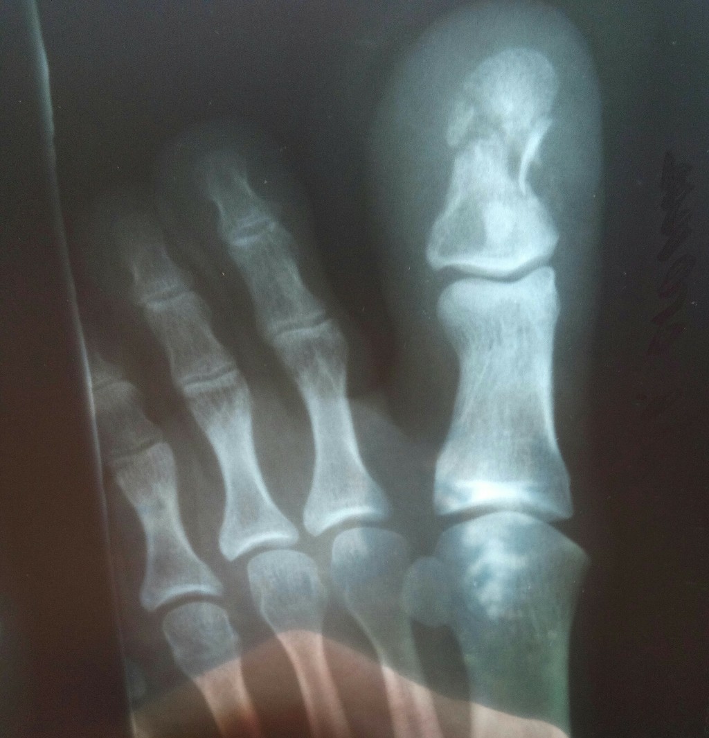 Ногтевая фаланга стопы. Оскольчатый перелом пальца ноги рентген. Краевой перелом дистальной фаланги. Перелом фаланги мизинца рентген. Перелом фаланги пальца стопы рентген.