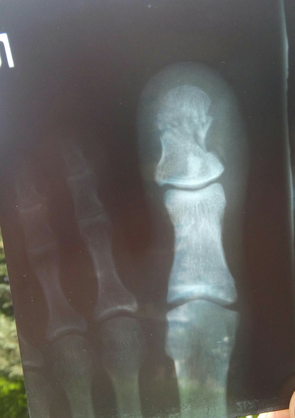 Как выглядит перелом пальца на ноге фото