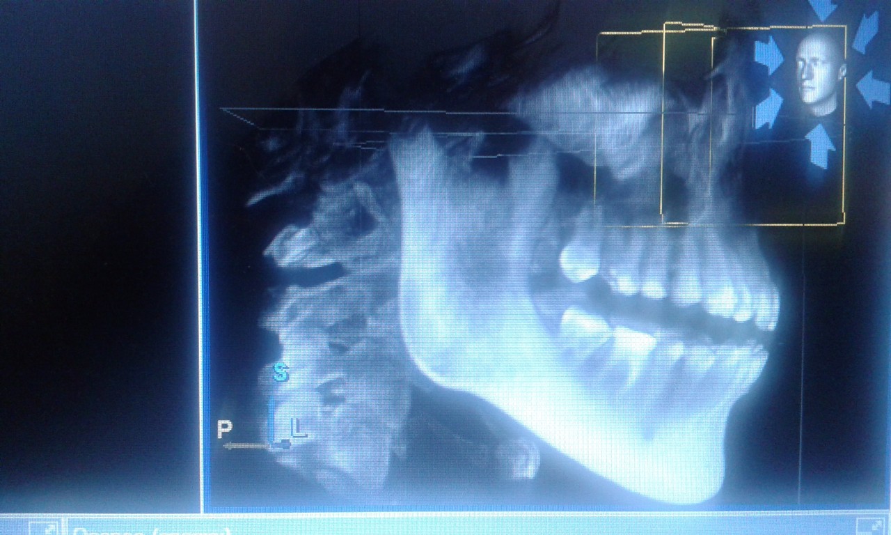 Кт верхней и нижней челюсти фото